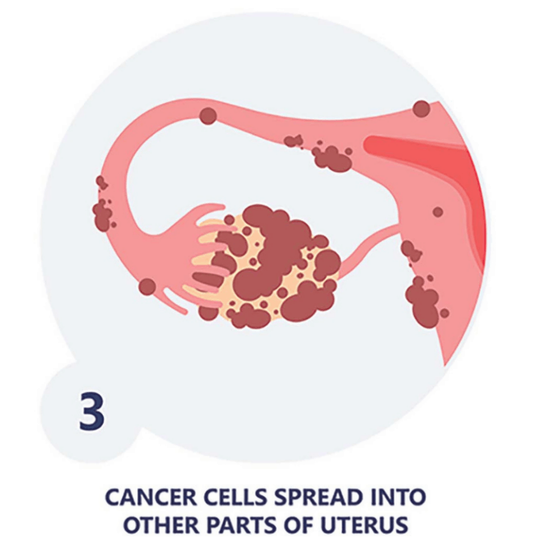 Black Women and Ovarian Cancer Resilient Sisterhood Project